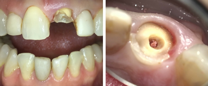 frontal and occlusal view