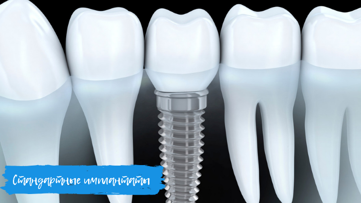 Какие именно зубные имплантаты выбрать?