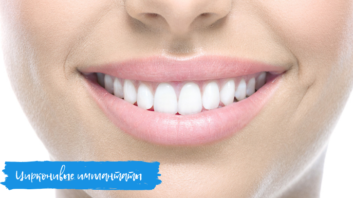 Какие именно зубные имплантаты выбрать?