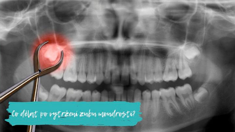 Co jíst po operaci zubů?