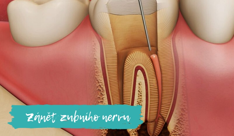 Co na bolest nervu v zubu?